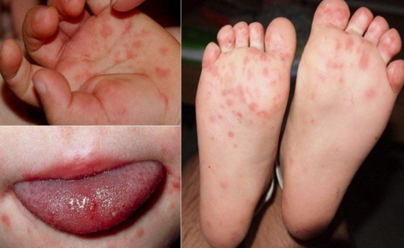 9 bệnh da liễu nguy hiểm ở trẻ