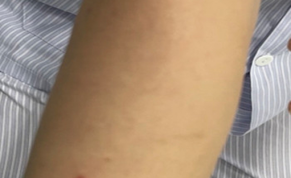 Bệnh nh&acirc;n đầu ti&ecirc;n mắc đậu m&ugrave;a khỉ đ&atilde; &acirc;m t&iacute;nh với virus
