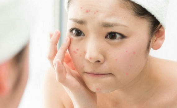 4 b&iacute; quyết v&agrave;ng bạn nhất định phải biết để trị hết th&acirc;m mụn