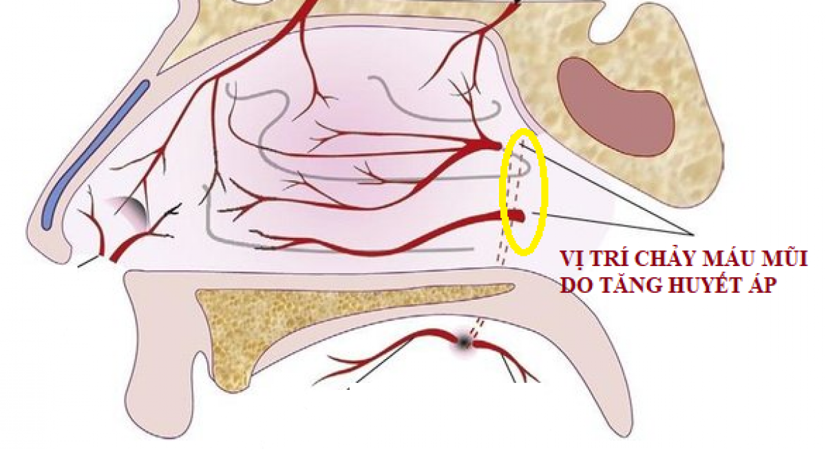 Cách Sơ Cứu Khi Chảy Máu Mũi Do Tăng Huyết Áp