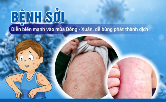 Thủ tướng y&ecirc;u cầu tăng cường c&ocirc;ng t&aacute;c ph&ograve;ng, chống bệnh sởi
