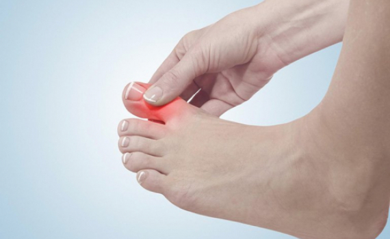 C&aacute;c phương pháp tự nhi&ecirc;n giúp giảm n&ocirc;̀ng đ&ocirc;̣ axit uric trong cơ th&ecirc;̉