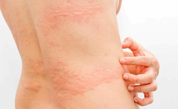 Triệu chứng v&agrave; c&aacute;ch ph&ograve;ng ngừa m&agrave;y đay m&ugrave;a lạnh