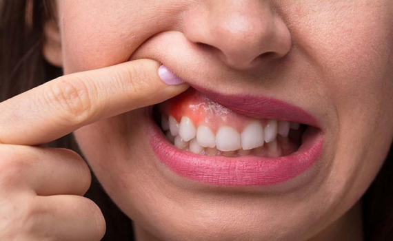 Những bệnh về răng miệng thường gặp cần ch&uacute; &yacute;