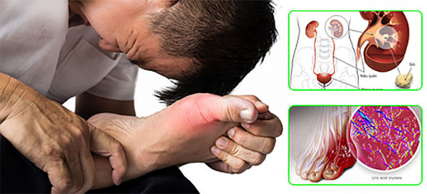 Kiểm soát biến chứng là mục tiêu hàng đầu để duy trì tuổi thọ cho người bệnh gút 