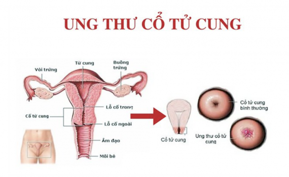 10 dấu hiệu ung thư cổ tử cung
