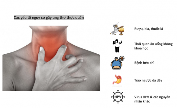 Những th&oacute;i quen ăn uống l&agrave;m tăng nguy cơ ung thư thực quản