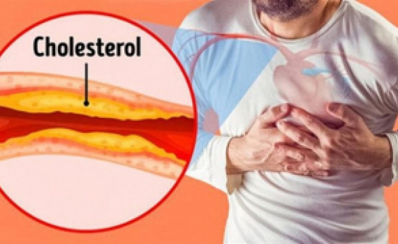 Hậu quả của rối loạn mỡ m&aacute;u m&agrave; nhiều người kh&ocirc;ng biết