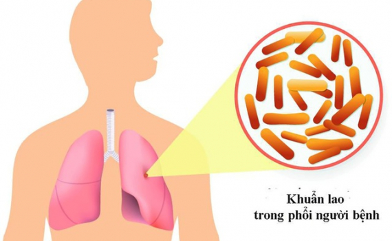Thủ tướng chỉ đạo tăng cường c&ocirc;ng t&aacute;c ph&ograve;ng, chống bệnh Lao