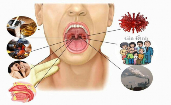 9 yếu tố nguy cơ g&acirc;y n&ecirc;n bệnh ung thư v&ograve;m hầu hiếm gặp