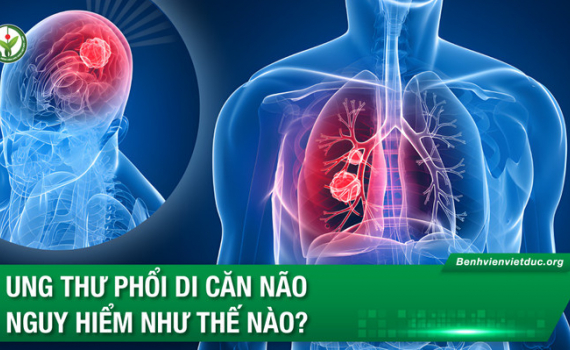 Cảnh b&aacute;o những triệu chứng c&oacute; nguy cơ bị ung thư phổi di căn n&atilde;o