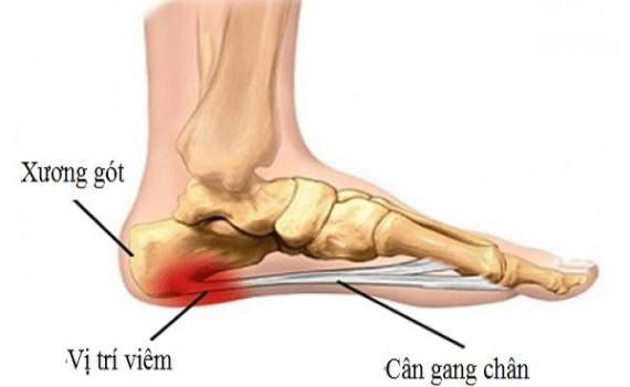 C&aacute;c triệu chứng ph&aacute;t hiện sớm bệnh Vi&ecirc;m c&acirc;n gan ch&acirc;n