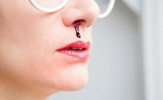 Xử tr&iacute; thế n&agrave;o khi chảy m&aacute;u cam m&ugrave;a nắng n&oacute;ng ?
