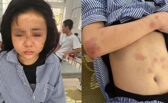 Khởi tố kẻ cuồng y&ecirc;u đ&aacute;nh đập bạn g&aacute;i suốt 2 tiếng
