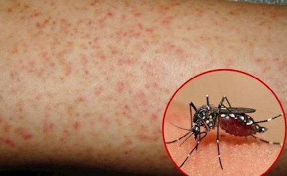 Tăng cường c&ocirc;ng t&aacute;c ph&ograve;ng, chống bệnh sốt xuất huyết