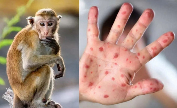WHO sắp họp khẩn về bệnh đậu m&ugrave;a khỉ