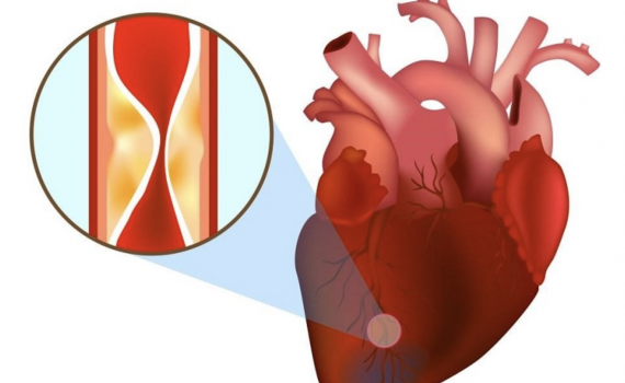 Dấu hiệu nhận biết bệnh nhồi m&aacute;u cơ tim
