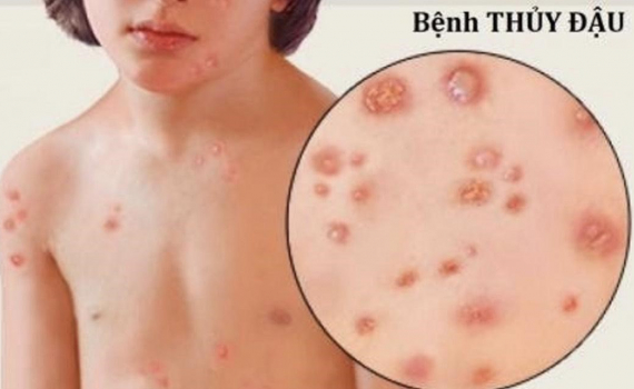 C&aacute;ch ph&ograve;ng tr&aacute;nh bệnh thủy đậu ở trẻ em