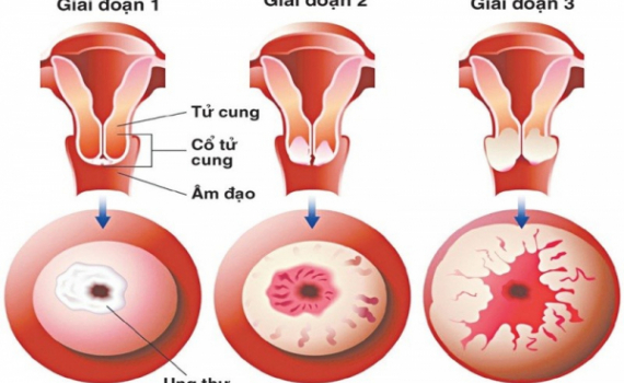 Dấu hiệu ung thư cổ tử cung v&agrave; phương ph&aacute;p ph&ograve;ng ngừa bệnh