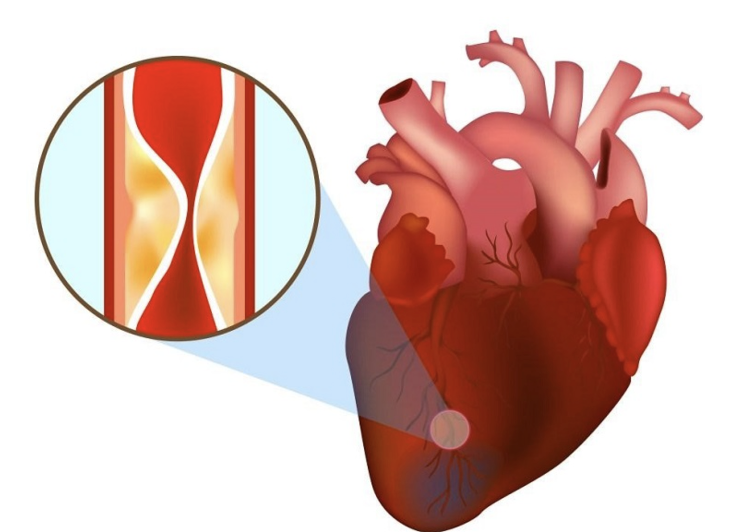 Dấu hiệu nhận biết bệnh nhồi máu cơ tim - Đài Phát thanh và Truyền ...