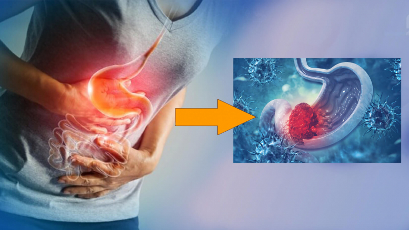 Tỷ lệ ung thư dạ dày ngày càng trẻ hoá, bác sĩ cảnh báo - Báo và Phát thanh - Truyền hình Ninh Bình