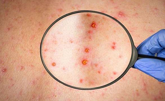 Bệnh đậu m&ugrave;a khỉ: Triệu chứng v&agrave; ph&ograve;ng tr&aacute;nh