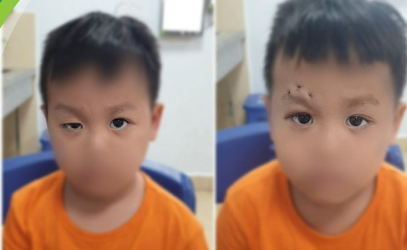 Sụp mi ở trẻ em, biểu hiện của bệnh l&yacute; nguy hiểm, b&aacute;c sĩ khuyến c&aacute;o