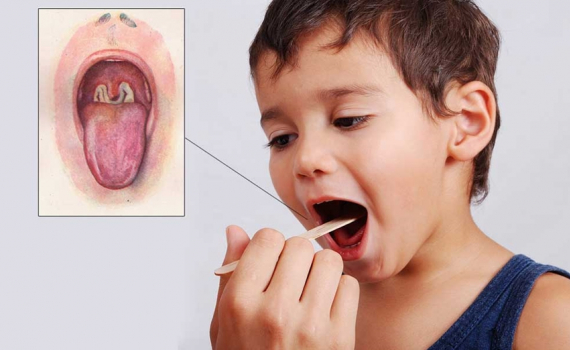 Bệnh bạch hầu: Nguy cơ l&acirc;y lan ra cộng đồng thấp