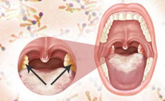 Những dấu hiệu nhận biết gi&uacute;p điều trị bệnh bạch hầu