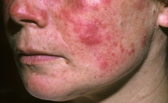 Những biến chứng thường gặp của bệnh lupus ban đỏ