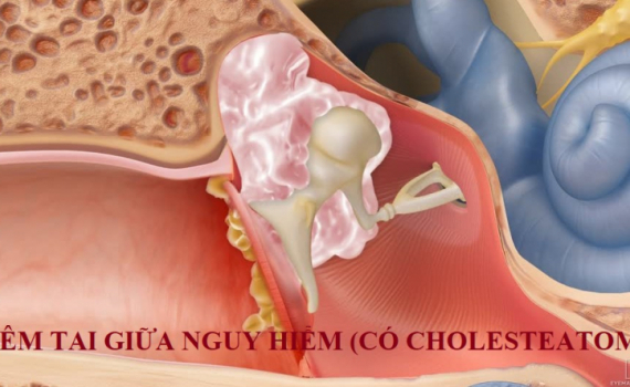 Ph&aacute;t hiện sớm c&aacute;c biến chứng từ bệnh vi&ecirc;m tai giữa