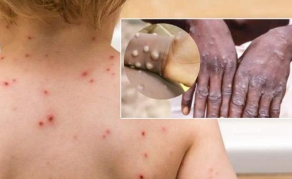 Ninh B&igrave;nh: Tăng cường c&ocirc;ng t&aacute;c ph&ograve;ng, chống bệnh Đậu m&ugrave;a khỉ