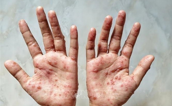 Bộ Y tế hướng dẫn gi&aacute;m s&aacute;t, ph&aacute;t hiện sớm ca bệnh đậu m&ugrave;a khỉ như thế n&agrave;o?