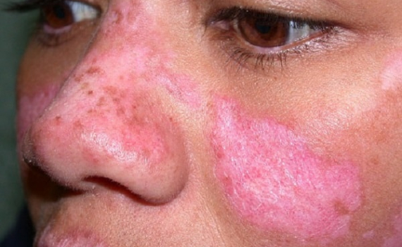 Cảnh b&aacute;o bệnh Lupus ban đỏ hệ thống: H&agrave;ng trăm ngh&igrave;n người mắc mỗi năm