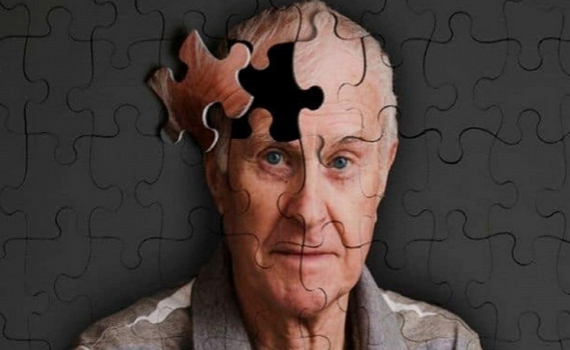 Alzheimer v&agrave; những dấu hiệu sớm cần lưu &yacute;