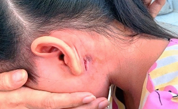 Ph&ograve;ng ngừa bệnh vi khuẩn &ldquo;ăn thịt người&rdquo; Whitmore thế n&agrave;o?
