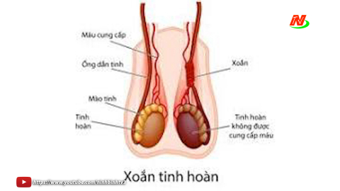 Đề ph&ograve;ng bệnh vi&ecirc;m xoắn tinh ho&agrave;n ở trẻ em